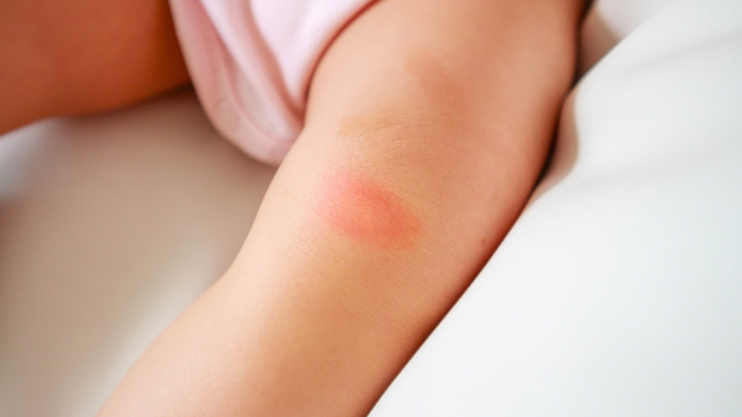 La puntura di insetti o zanzare può causare reazioni allergiche, anche se il tuo piccolo non è allergico!